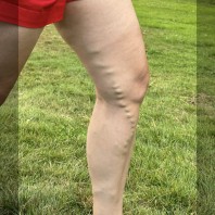 Varicose Veins - Learn the Risks and How to Keep your Legs Healthy